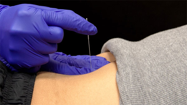 Pelvic Floor Therapy and Dry Needling